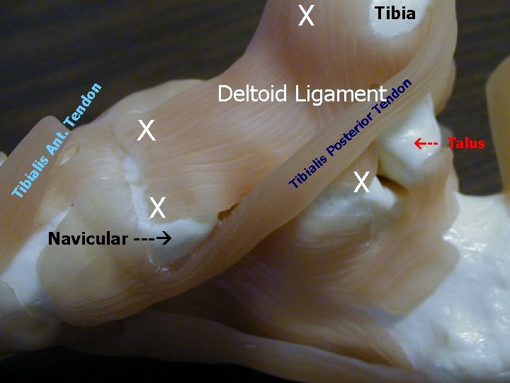 X n o d An t. Te nd o n Deltoid Ligamenten T r X n o d An t. Te nd o n Deltoid Ligamenten T r