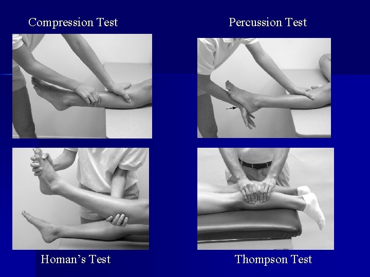 Compression Test Homan’s Test Percussion Test Thompson Test 