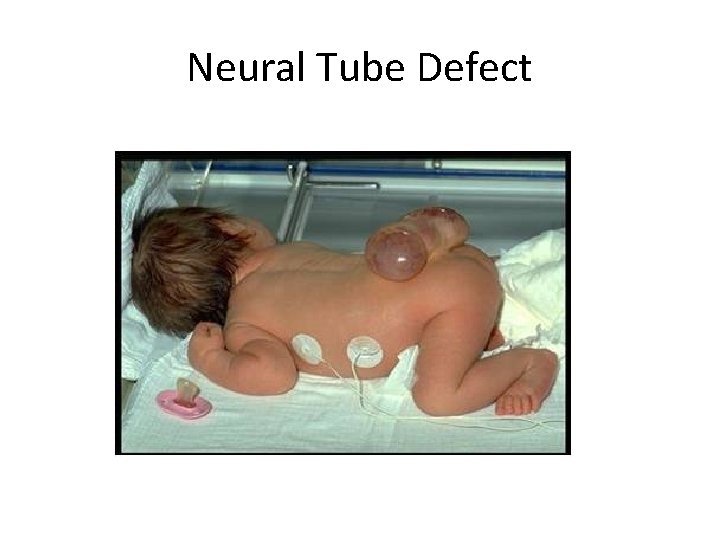Neural Tube Defect 