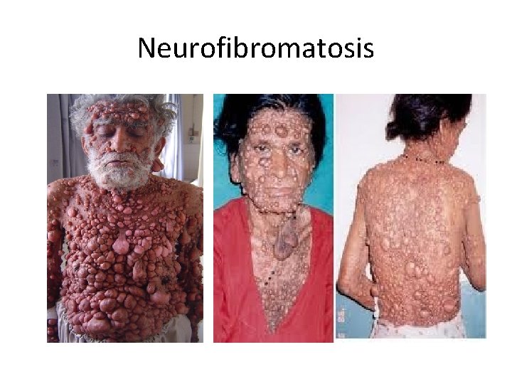 Neurofibromatosis 