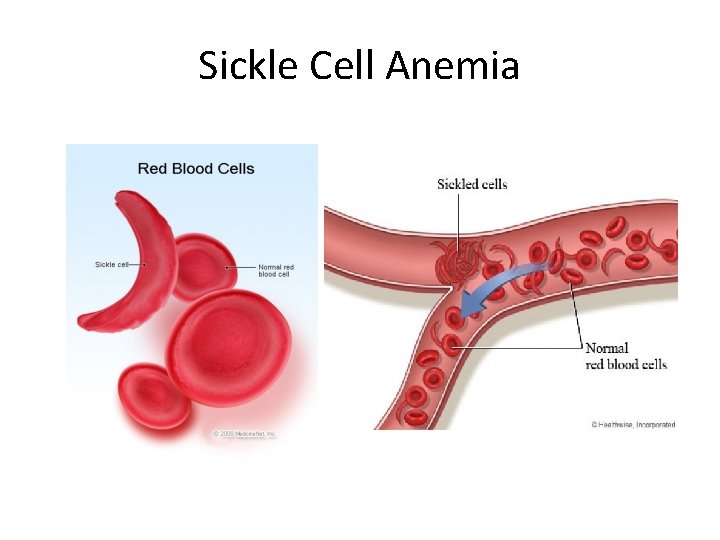 Sickle Cell Anemia 