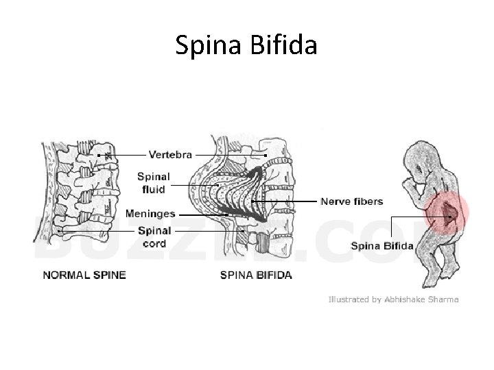 Spina Bifida 