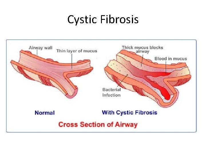 Cystic Fibrosis 