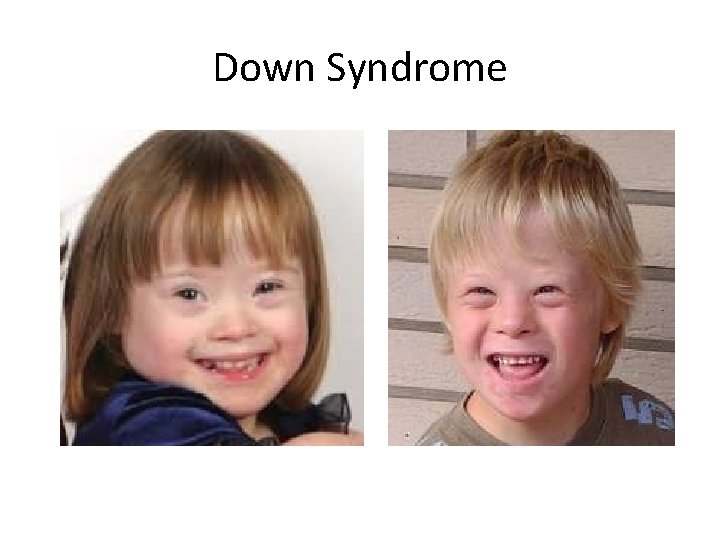 Down Syndrome 