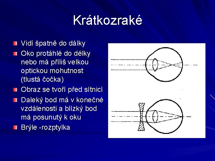 Krátkozraké Vidí špatně do dálky Oko protáhlé do délky nebo má příliš velkou optickou