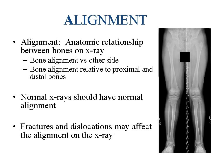 ALIGNMENT • Alignment: Anatomic relationship between bones on x-ray – Bone alignment vs other