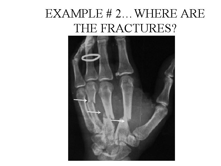 EXAMPLE # 2…WHERE ARE THE FRACTURES? 