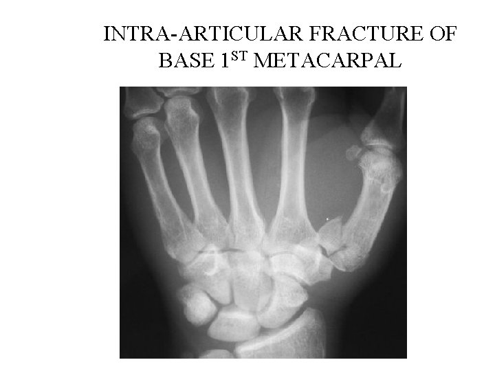 INTRA-ARTICULAR FRACTURE OF BASE 1 ST METACARPAL 