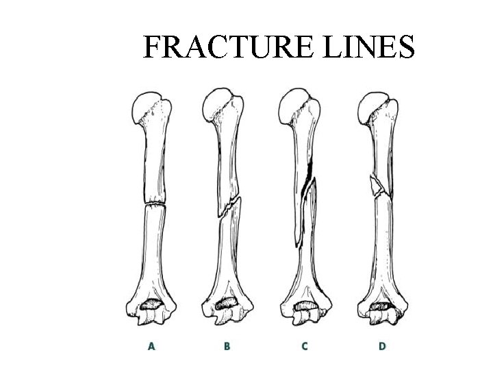 FRACTURE LINES 