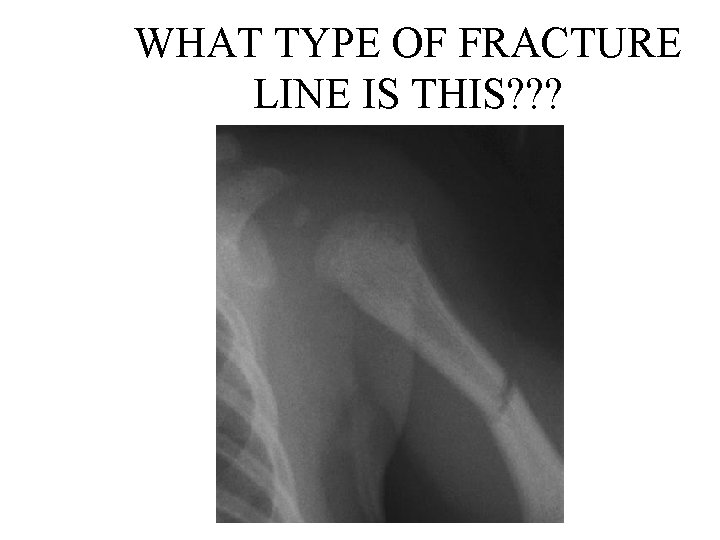 WHAT TYPE OF FRACTURE LINE IS THIS? ? ? 