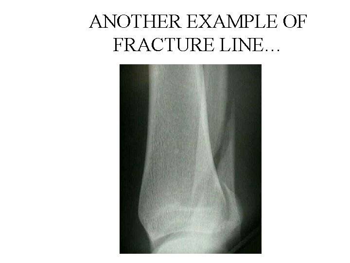 ANOTHER EXAMPLE OF FRACTURE LINE… 