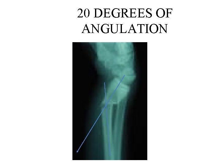 20 DEGREES OF ANGULATION 