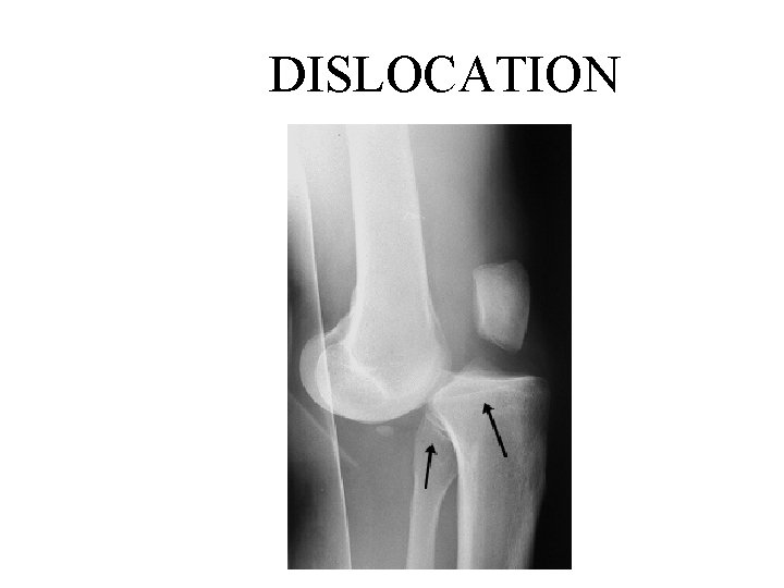 DISLOCATION 