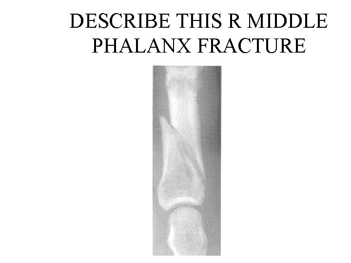 DESCRIBE THIS R MIDDLE PHALANX FRACTURE 