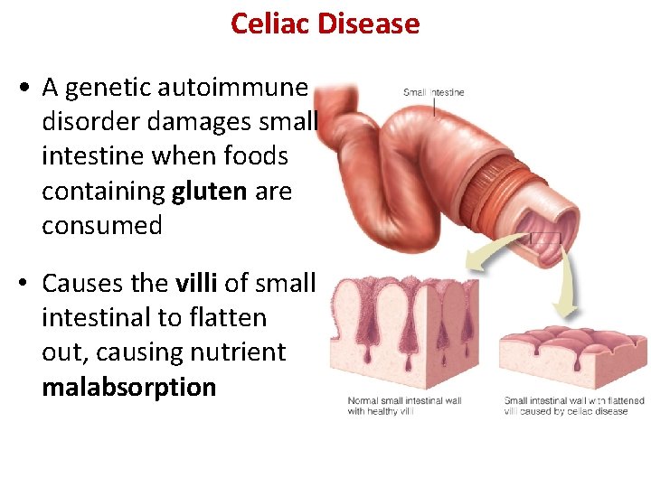 Celiac Disease • A genetic autoimmune disorder damages small intestine when foods containing gluten