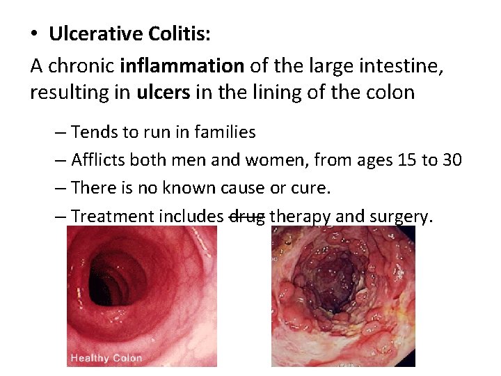  • Ulcerative Colitis: A chronic inflammation of the large intestine, resulting in ulcers