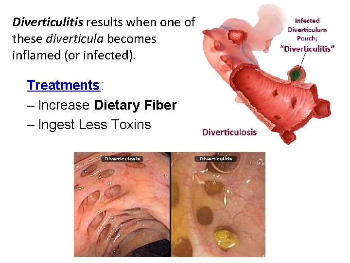 Diverticulitis results when one of these diverticula becomes inflamed (or infected). Treatments: – Increase