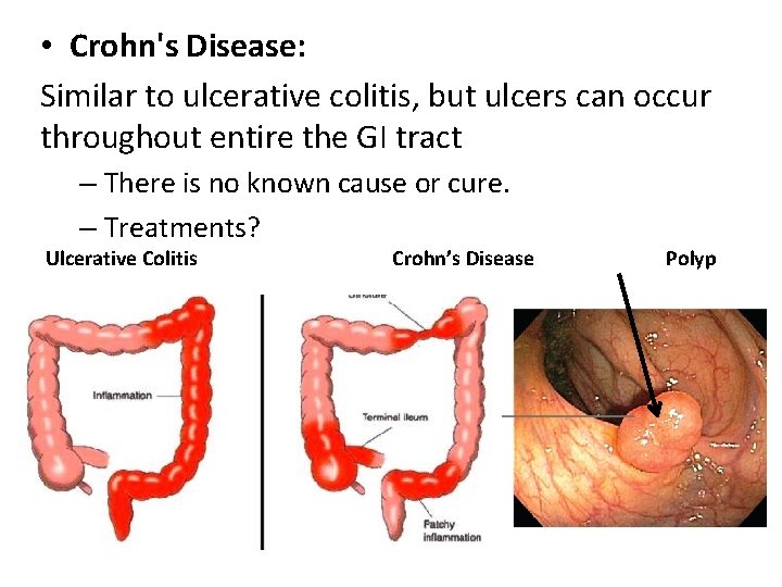  • Crohn's Disease: Similar to ulcerative colitis, but ulcers can occur throughout entire