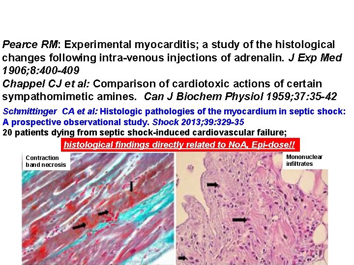 Pearce RM: Experimental myocarditis; a study of the histological changes following intra-venous injections of