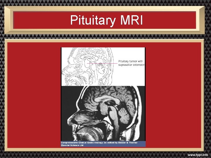Pituitary MRI 