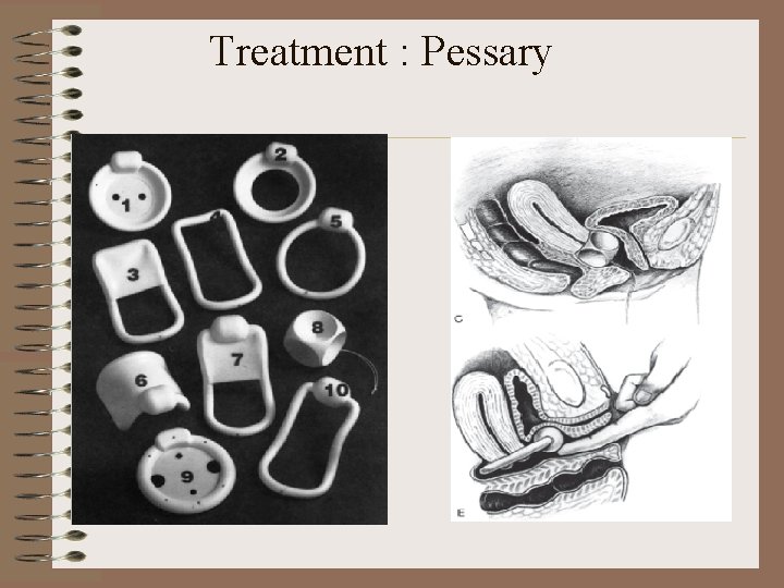 Treatment : Pessary 