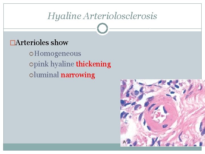 Hyaline Arteriolosclerosis �Arterioles show Homogeneous pink hyaline thickening luminal narrowing 