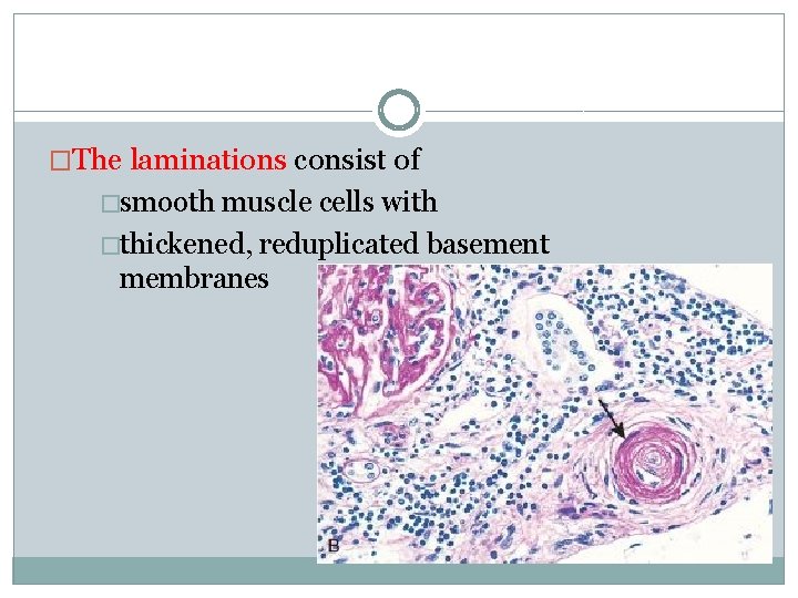 �The laminations consist of �smooth muscle cells with �thickened, reduplicated basement membranes 