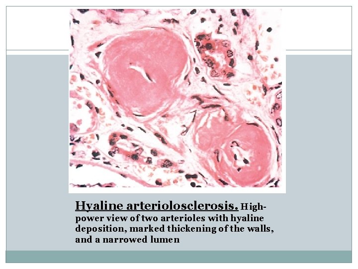 Hyaline arteriolosclerosis. Highpower view of two arterioles with hyaline deposition, marked thickening of the