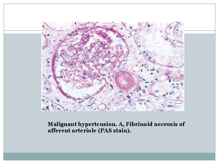 Malignant hypertension. A, Fibrinoid necrosis of afferent arteriole (PAS stain). 