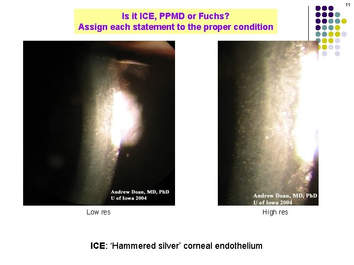 11 Is it ICE, PPMD or Fuchs? Assign each statement to the proper condition