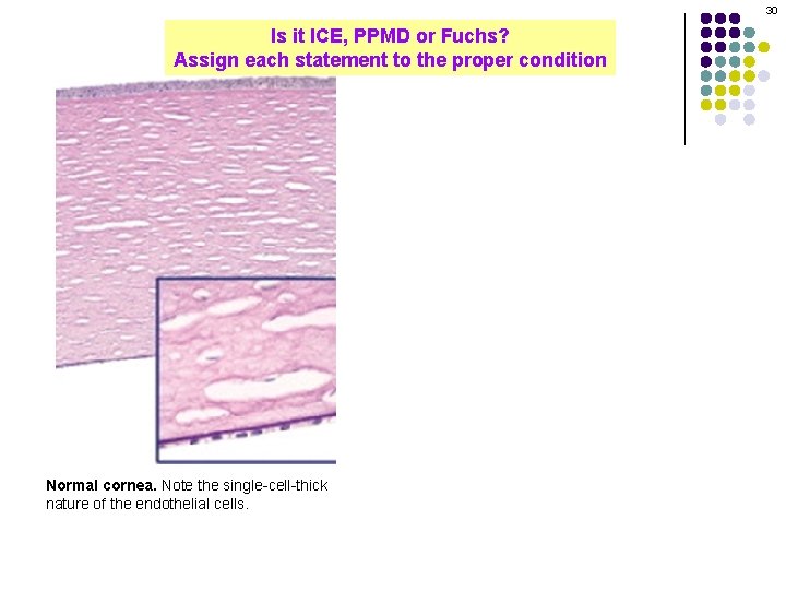30 Is it ICE, PPMD or Fuchs? Assign each statement to the proper condition