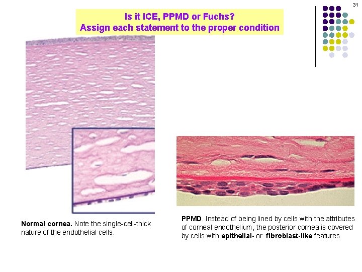 31 Is it ICE, PPMD or Fuchs? Assign each statement to the proper condition