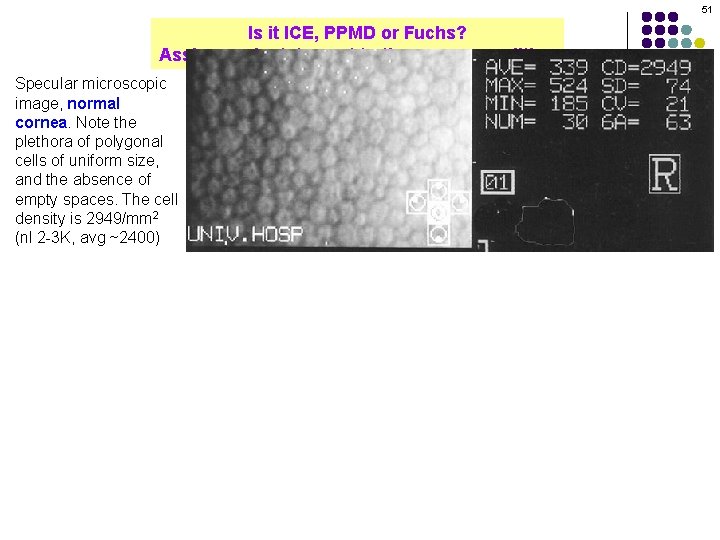 51 Is it ICE, PPMD or Fuchs? Assign each statement to the proper condition