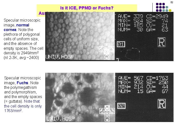 52 Is it ICE, PPMD or Fuchs? Assign each statement to the proper condition