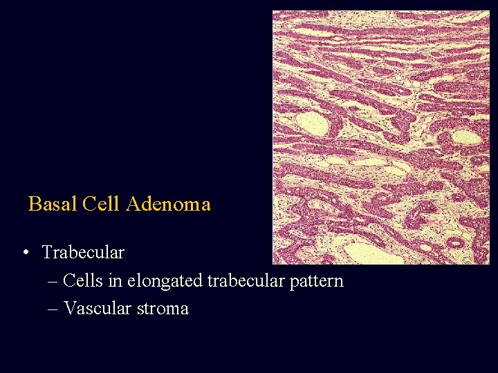 Basal Cell Adenoma • Trabecular – Cells in elongated trabecular pattern – Vascular stroma Basal Cell Adenoma • Trabecular – Cells in elongated trabecular pattern – Vascular stroma