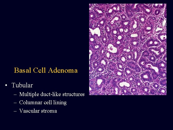 Basal Cell Adenoma • Tubular – Multiple duct-like structures – Columnar cell lining – Basal Cell Adenoma • Tubular – Multiple duct-like structures – Columnar cell lining –