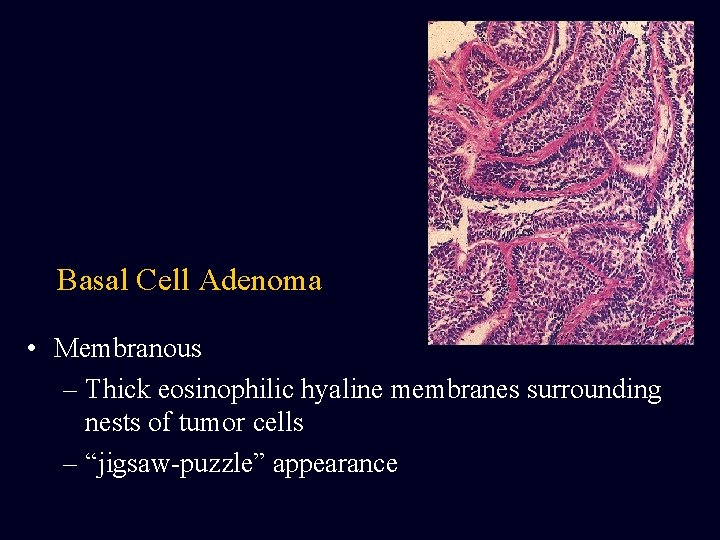 Basal Cell Adenoma • Membranous – Thick eosinophilic hyaline membranes surrounding nests of tumor Basal Cell Adenoma • Membranous – Thick eosinophilic hyaline membranes surrounding nests of tumor