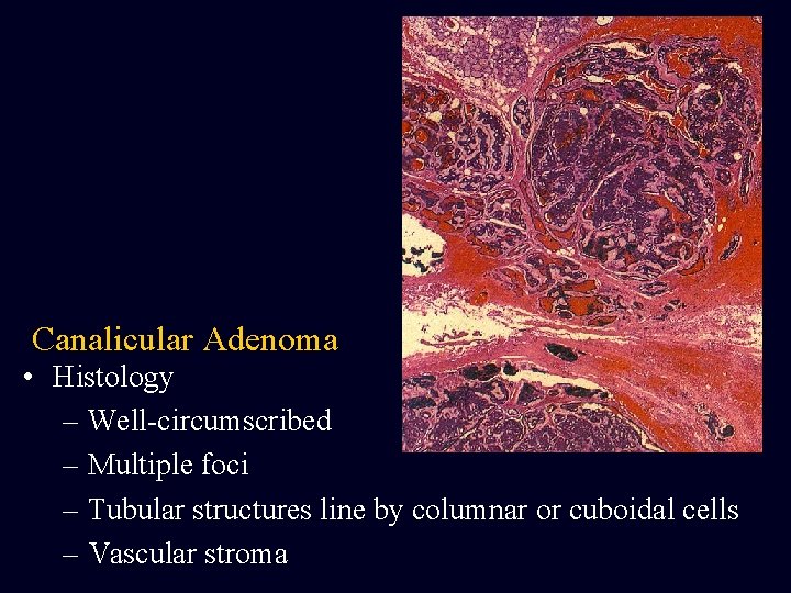 Canalicular Adenoma • Histology – Well-circumscribed – Multiple foci – Tubular structures line by Canalicular Adenoma • Histology – Well-circumscribed – Multiple foci – Tubular structures line by