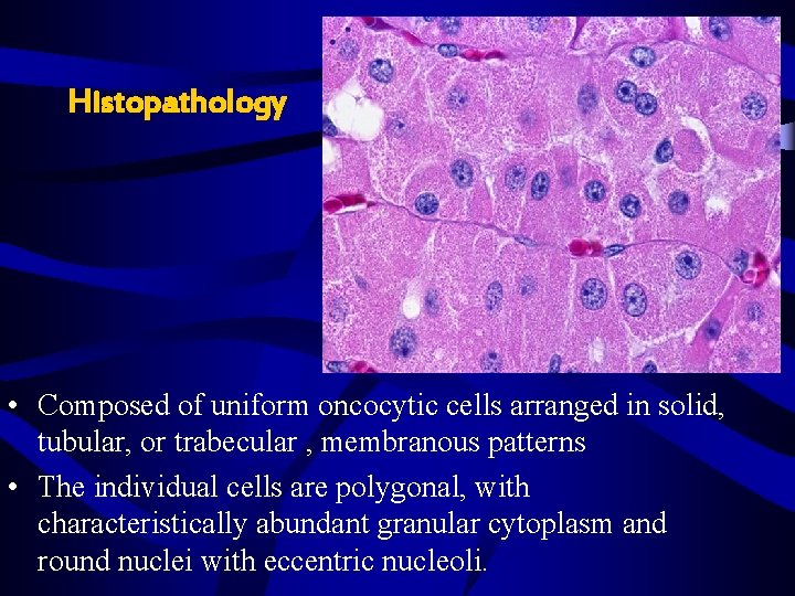 Histopathology • Composed of uniform oncocytic cells arranged in solid, tubular, or trabecular , Histopathology • Composed of uniform oncocytic cells arranged in solid, tubular, or trabecular ,