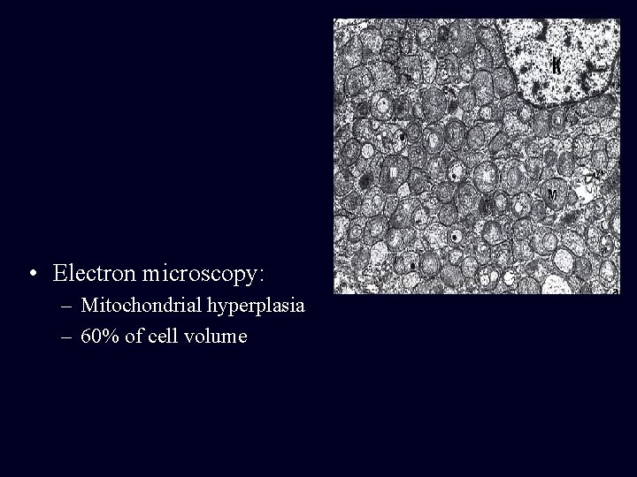 • Electron microscopy: – Mitochondrial hyperplasia – 60% of cell volume • Electron microscopy: – Mitochondrial hyperplasia – 60% of cell volume