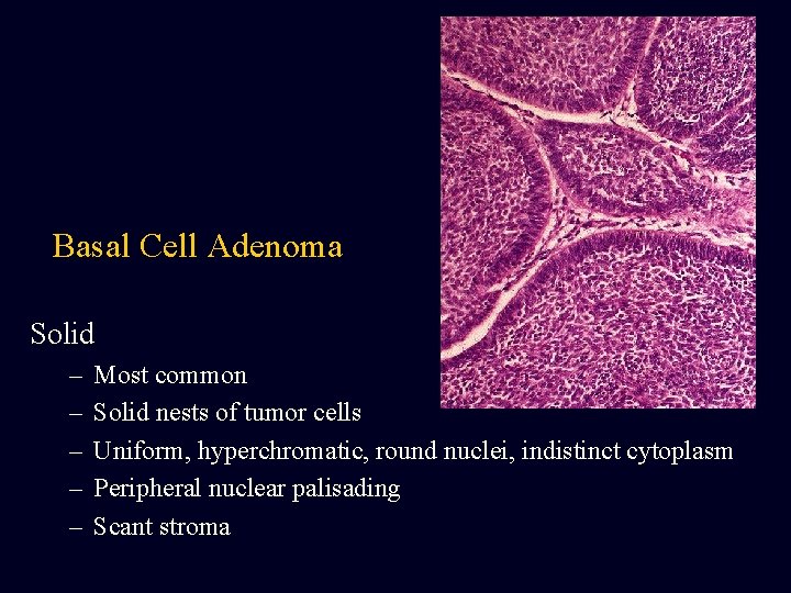 Basal Cell Adenoma Solid – – – Most common Solid nests of tumor cells Basal Cell Adenoma Solid – – – Most common Solid nests of tumor cells