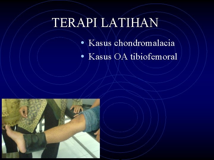 TERAPI LATIHAN • Kasus chondromalacia • Kasus OA tibiofemoral 