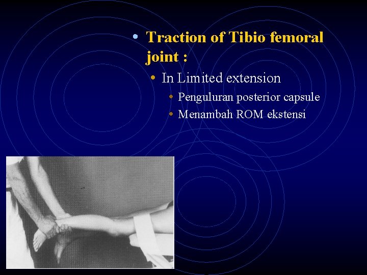  • Traction of Tibio femoral joint : • In Limited extension • Penguluran