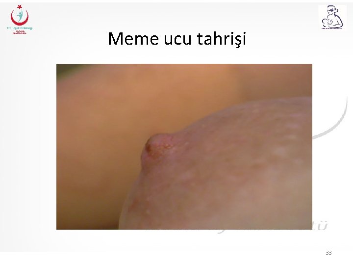 Meme ucu tahrişi 33 