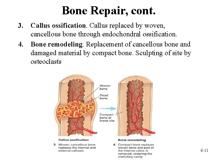 Bone Repair, cont. 3. Callus ossification. Callus replaced by woven, cancellous bone through endochondral