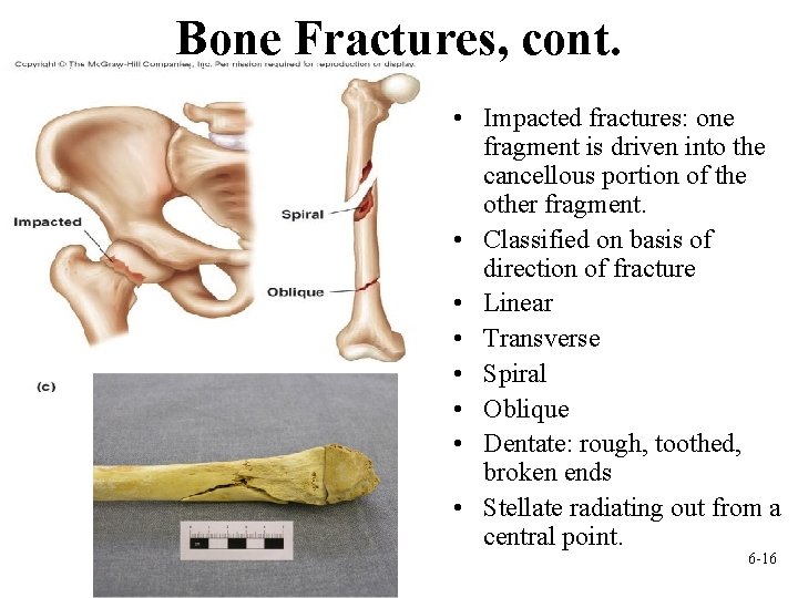 Bone Fractures, cont. • Impacted fractures: one fragment is driven into the cancellous portion