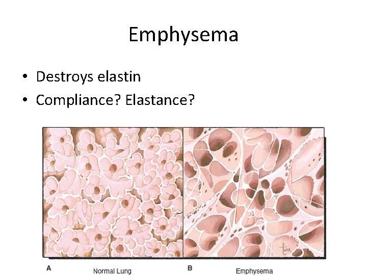 Emphysema • Destroys elastin • Compliance? Elastance? 