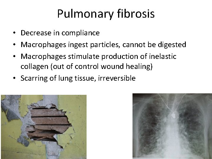 Pulmonary fibrosis • Decrease in compliance • Macrophages ingest particles, cannot be digested •