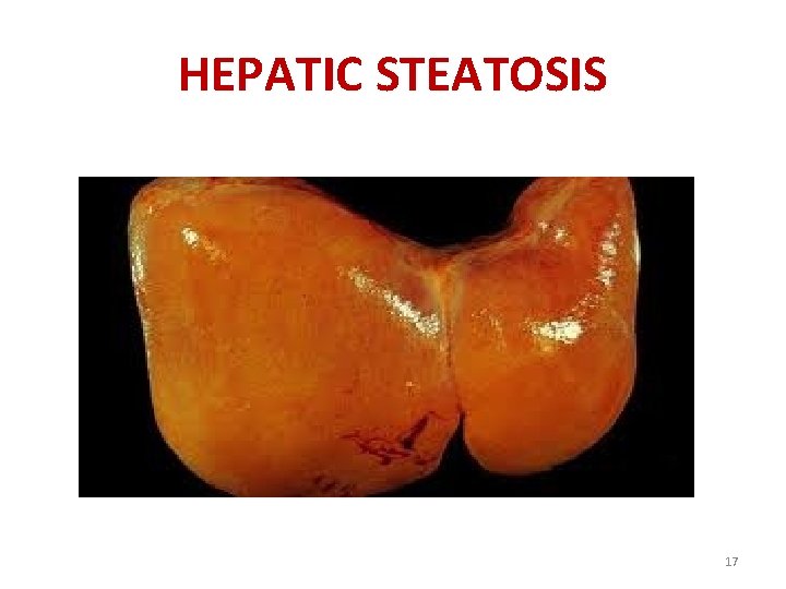 HEPATIC STEATOSIS 17 