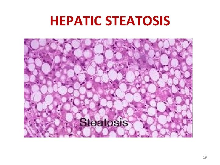 HEPATIC STEATOSIS 19 